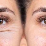 blefaroplastia em formiga, minas gerais