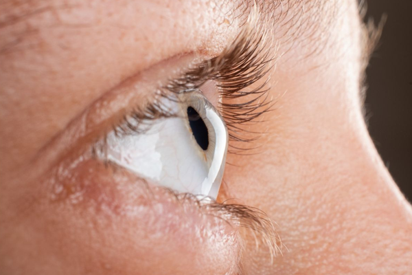 cirurgia de ceratocone