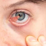 cirurgia de pterígio