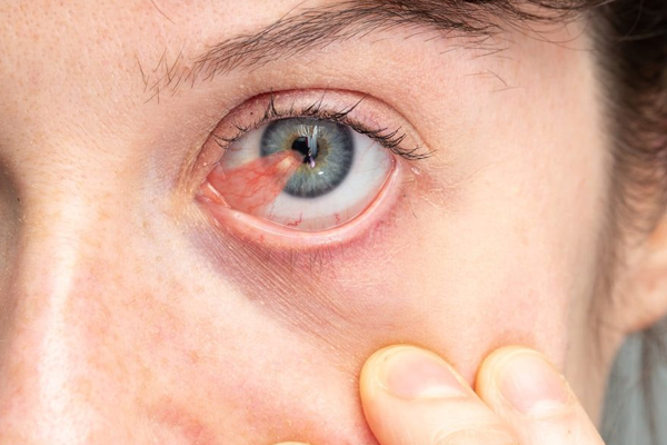 cirurgia de pterígio