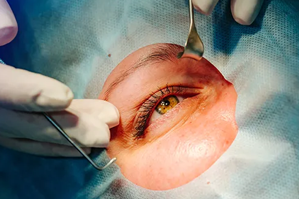 cirurgia de retina