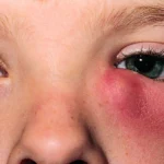 dacriocistorrinostomia