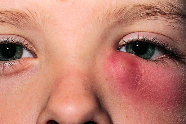 dacriocistorrinostomia